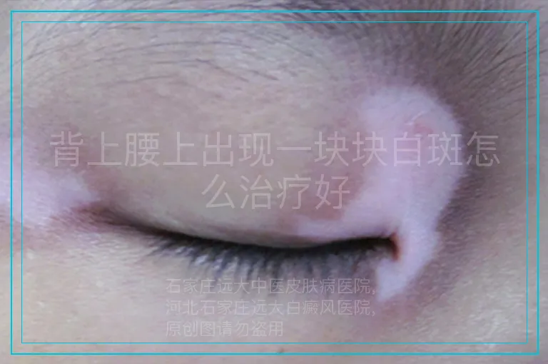 背上腰上出现一块块白斑怎么治疗好