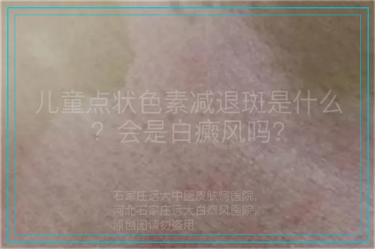 儿童点状色素减退斑是什么?会是白癜风吗?