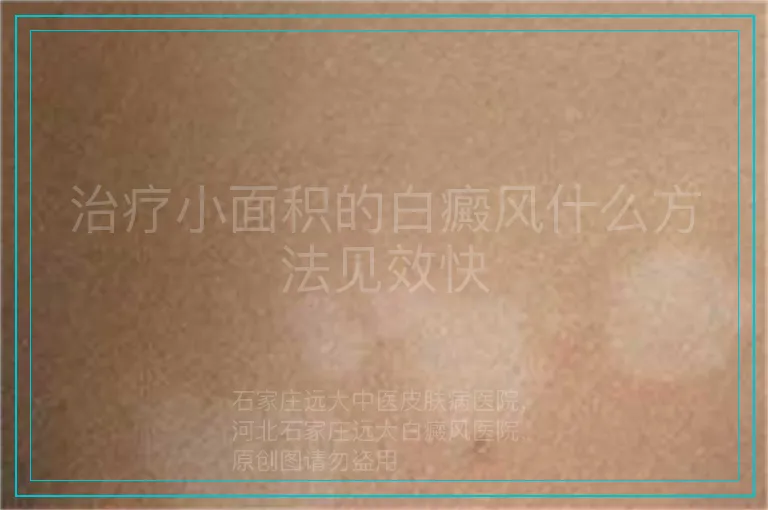 治疗小面积的白癜风什么方法见效快