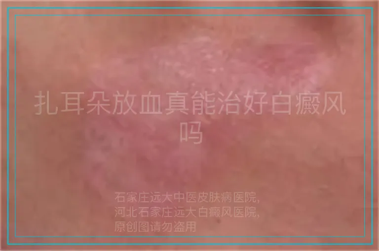 扎耳朵放血真能治好白癜风吗
