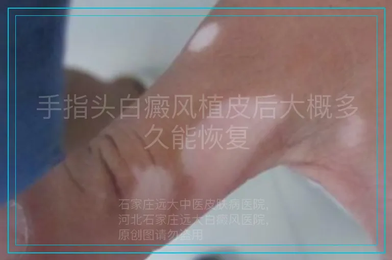 手指头白癜风植皮后大概多久能恢复