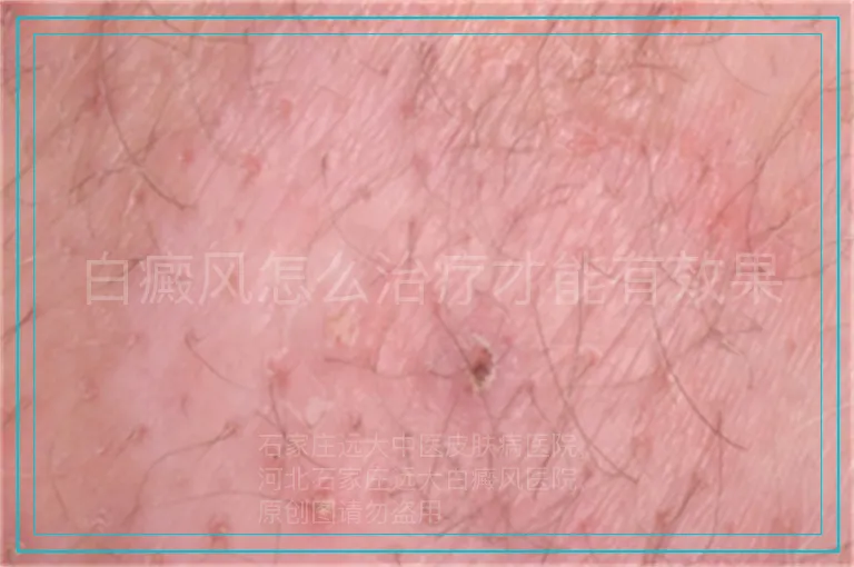 白癜风怎么治疗才能有效果