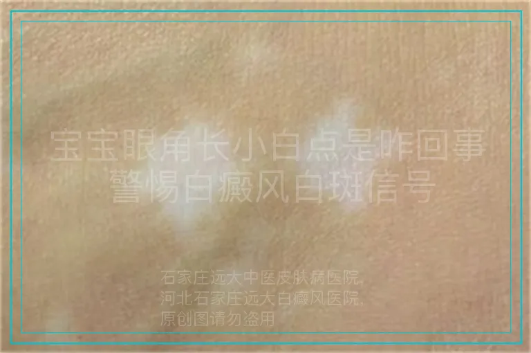 宝宝眼角长小白点是咋回事 警惕白癜风白斑信号