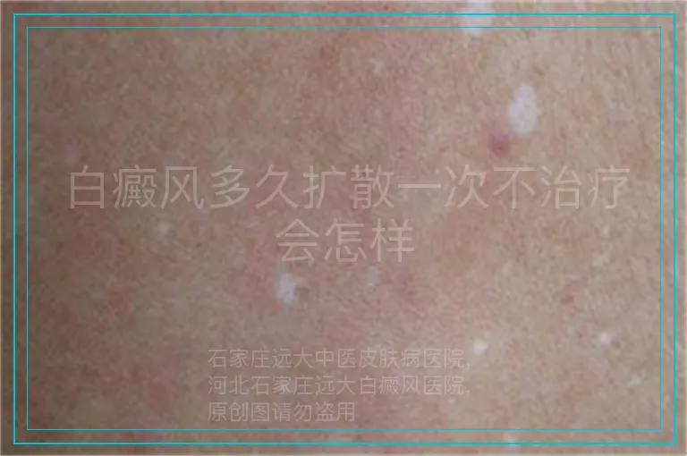 白癜风多久扩散一次不治疗会怎样