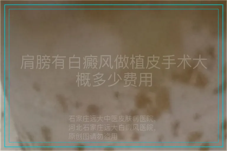 肩膀有白癜风做植皮手术大概多少费用