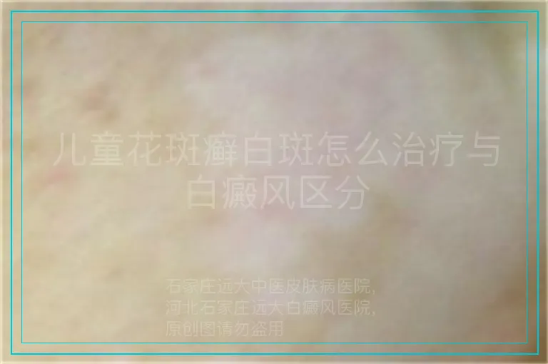 儿童花斑癣白斑怎么治疗与白癜风区分