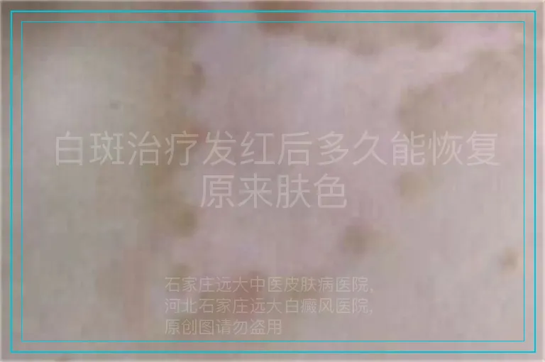 白斑治疗发红后多久能恢复原来肤色