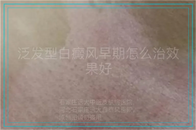 泛发型白癜风早期怎么治效果好