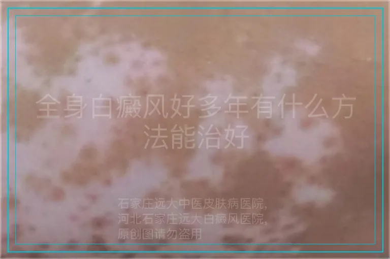 全身白癜风好多年有什么方法能治好