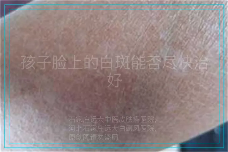 孩子脸上的白斑能否尽快治好