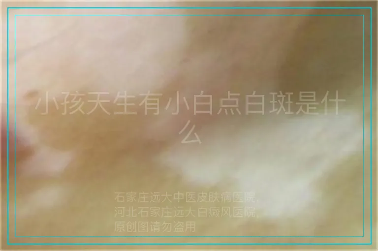 小孩天生有小白点白斑是什么