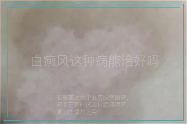 白癜风这种病能治好吗