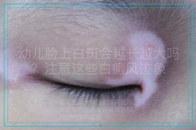 幼儿脸上白斑会越长越大吗？注意这些白癜风迹象