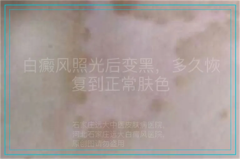 白癜风照光后变黑，多久恢复到正常肤色