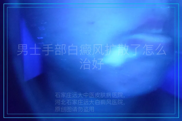 男士手部白癜风扩散了怎么治好