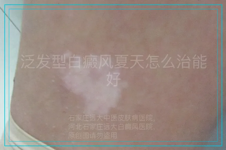 泛发型白癜风夏天怎么治能好