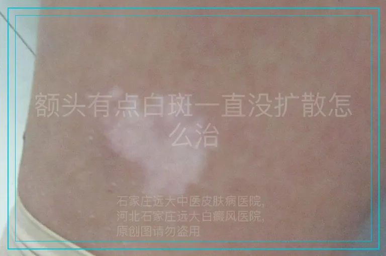 额头有点白斑一直没扩散怎么治