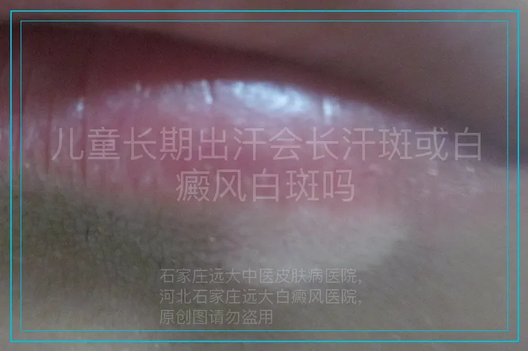 儿童长期出汗会长汗斑或白癜风白斑吗