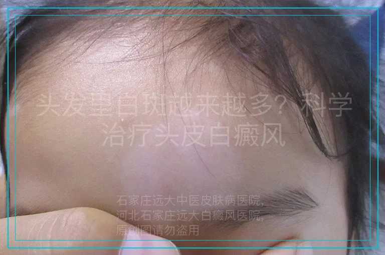 头发里白斑越来越多?科学治疗头皮白癜风