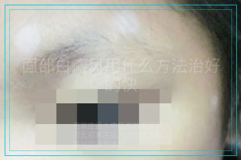 面部白癜风用什么方法治好的快