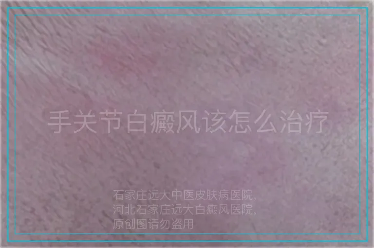 手关节白癜风该怎么治疗