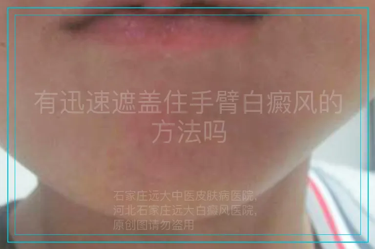 有迅速遮盖住手臂白癜风的方法吗