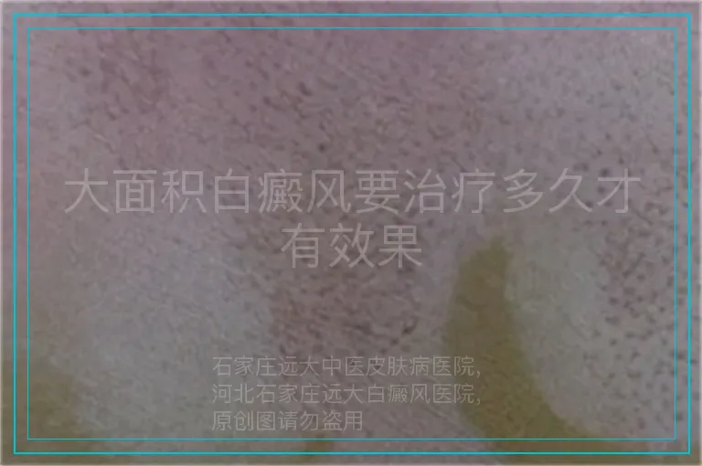 大面积白癜风要治疗多久才有效果