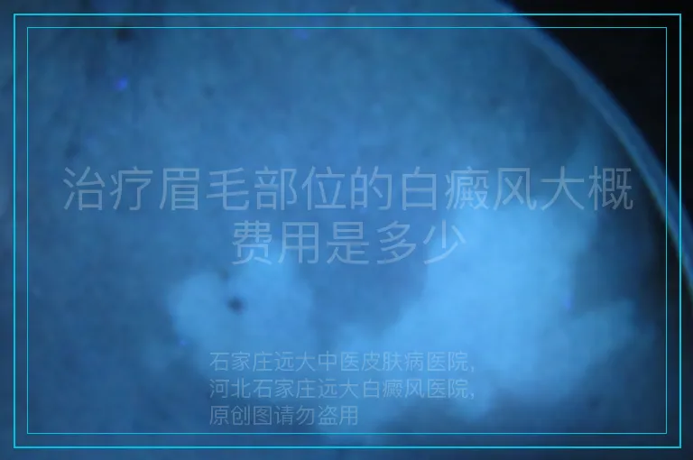 治疗眉毛部位的白癜风大概费用是多少