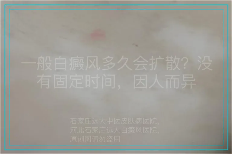一般白癜风多久会扩散？没有固定时间，因人而异