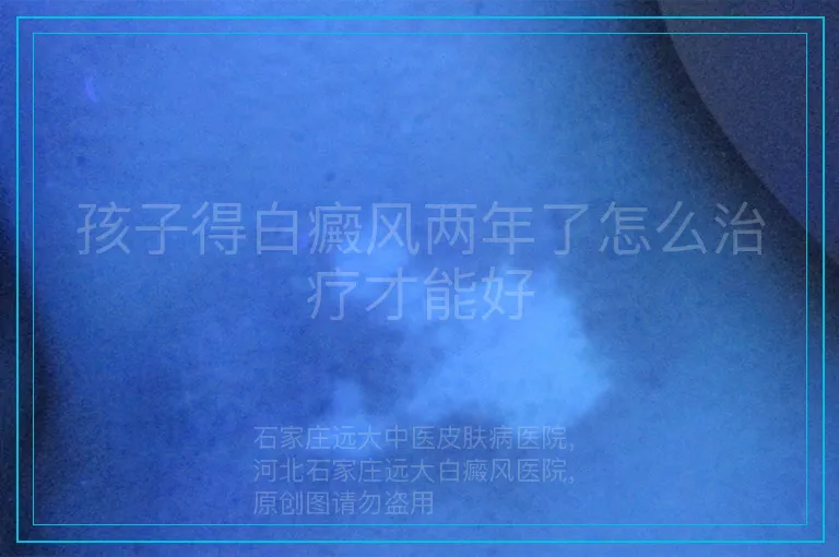 孩子得白癜风两年了怎么治疗才能好