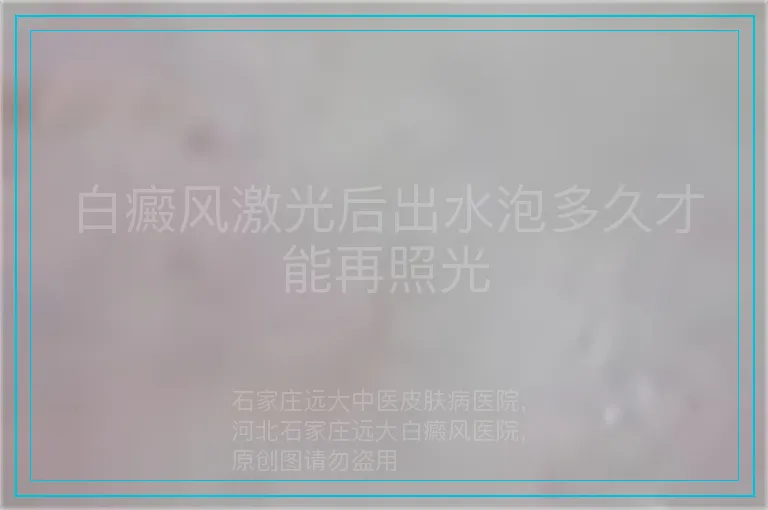 白癜风激光后出水泡多久才能再照光