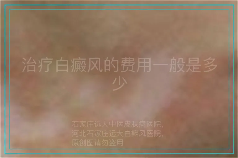 治疗白癜风的费用一般是多少