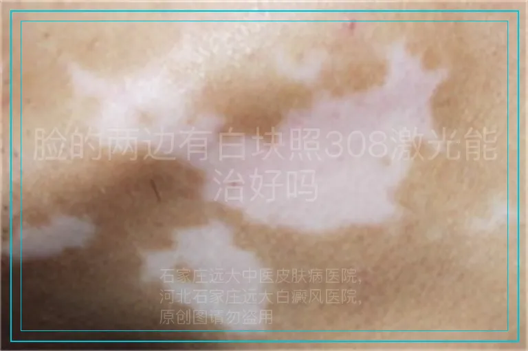 脸的两边有白块照308激光能治好吗