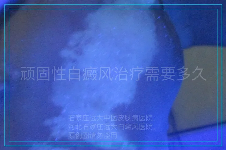 顽固性白癜风治疗需要多久