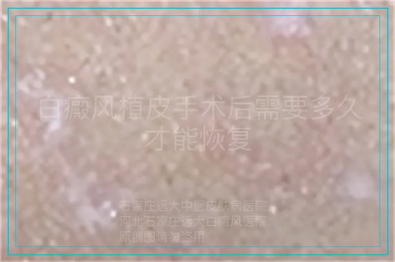 白癜风植皮手术后需要多久才能恢复