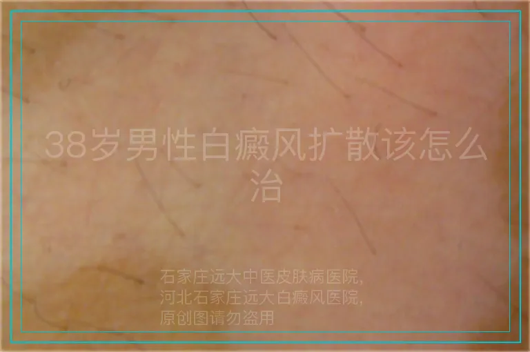 38岁男性白癜风扩散该怎么治