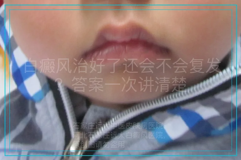 白癜风治好了还会不会复发?答案一次讲清楚
