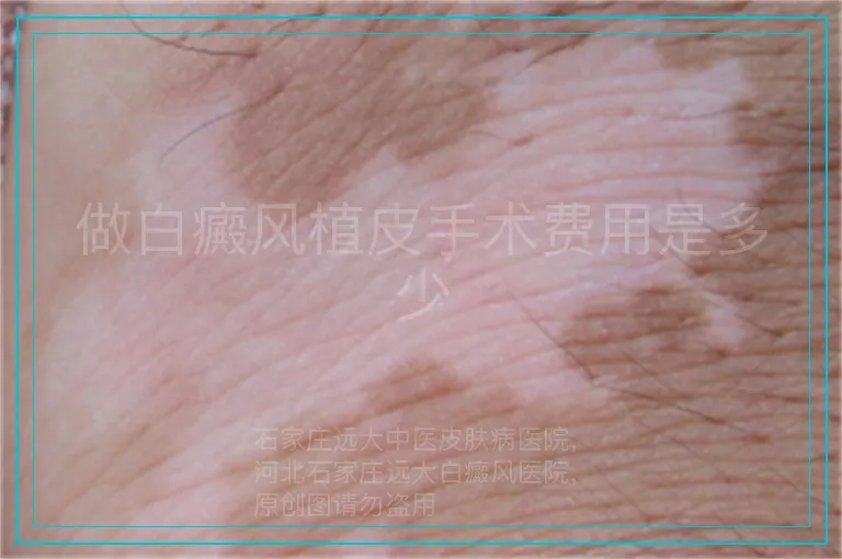 做白癜风植皮手术费用是多少