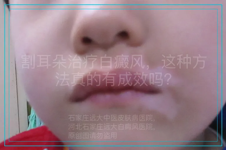 割耳朵治疗白癜风,这种方法真的有成效吗?
