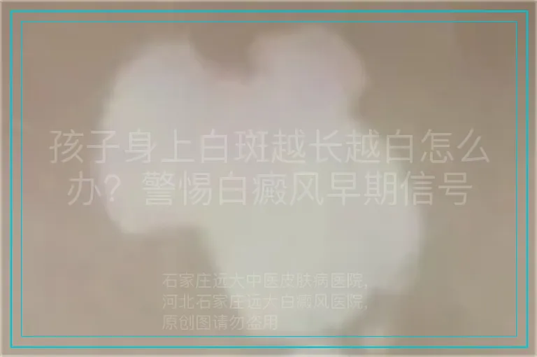孩子身上白斑越长越白怎么办?警惕白癜风早期信号