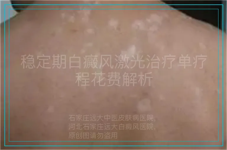 稳定期白癜风激光治疗单疗程花费解析