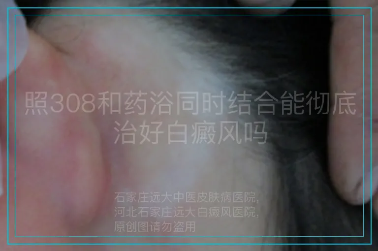 照308和药浴同时结合能彻底治好白癜风吗