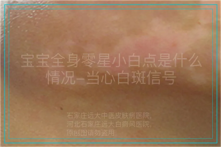 宝宝全身零星小白点是什么情况-当心白斑信号