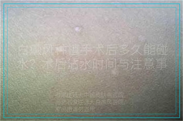 白癜风种植手术后多久能碰水?术后沾水时间与注意事项