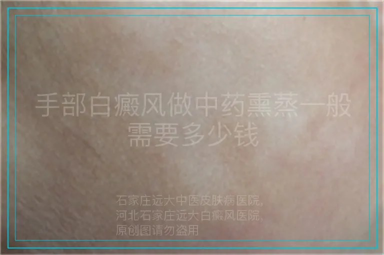 手部白癜风做中药熏蒸一般需要多少钱