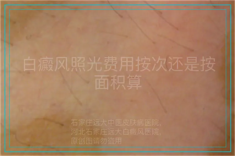 白癜风照光费用按次还是按面积算