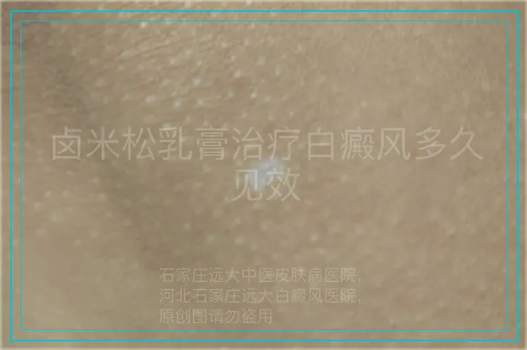 卤米松乳膏治疗白癜风多久见效