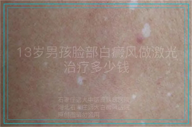 13岁男孩脸部白癜风做激光治疗多少钱