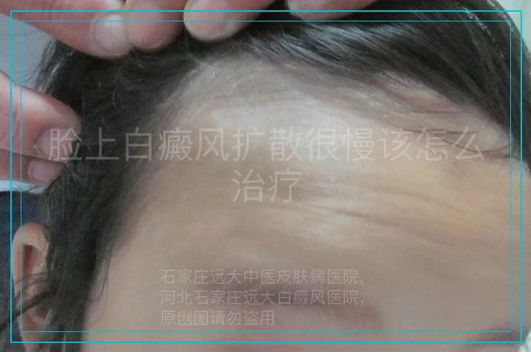 脸上白癜风扩散很慢该怎么治疗