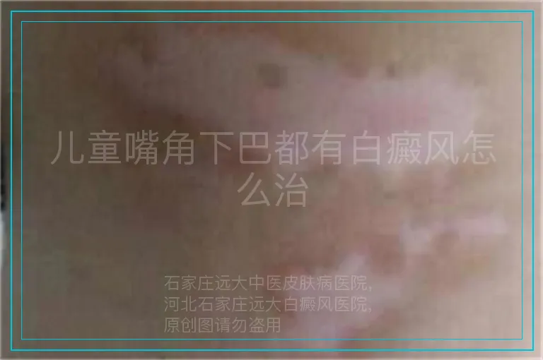 儿童嘴角下巴都有白癜风怎么治